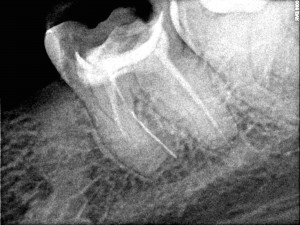 Instrumentas, pergydymas, gutaperca, kruminis